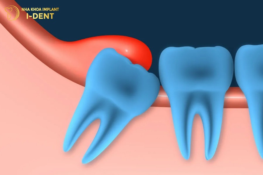 Sung-do-nuou-khi-moc-rang-khon