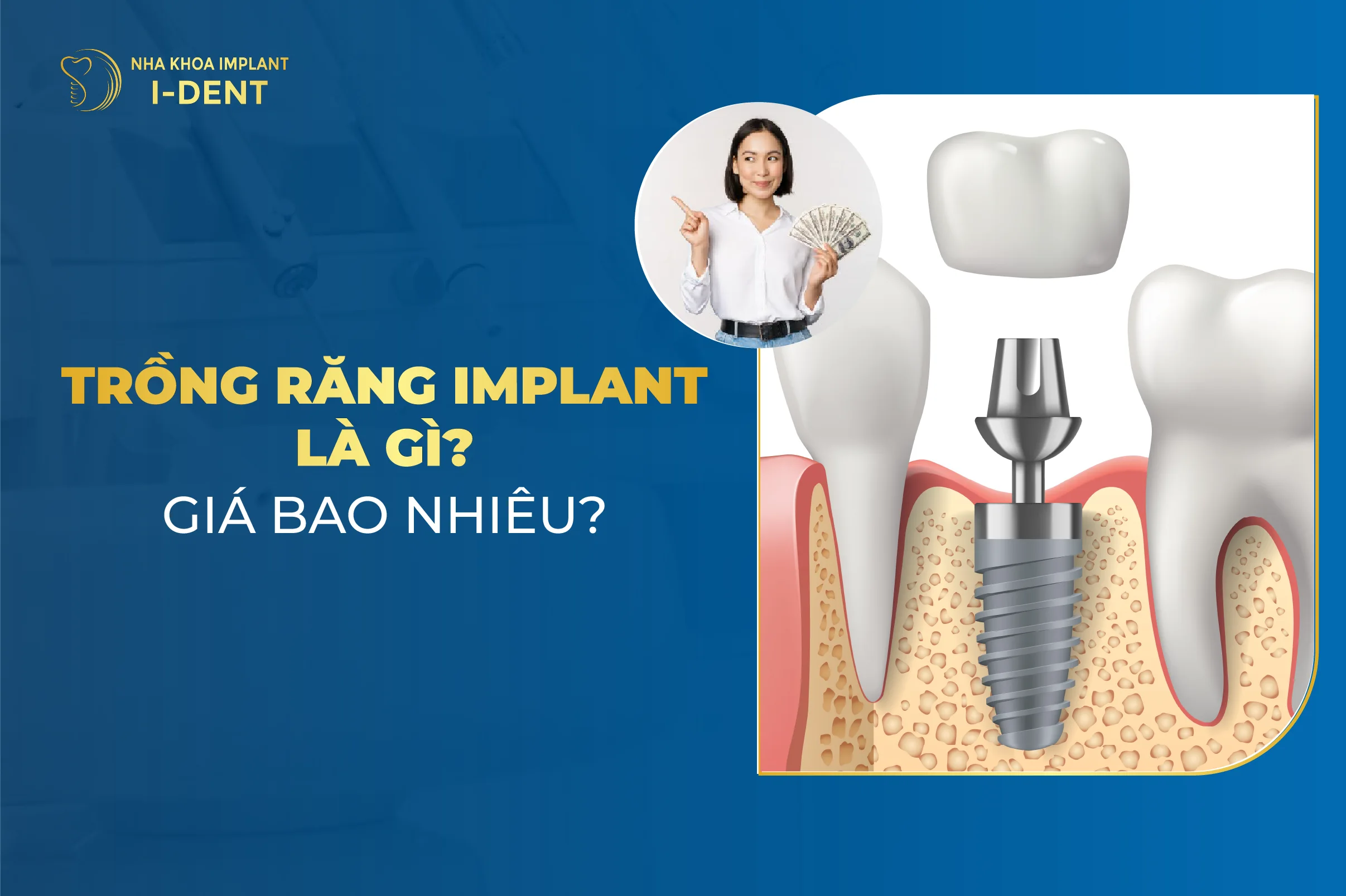 Trồng răng Implant: Giá, Ưu điểm, Quy trình và Địa chỉ cấy răng