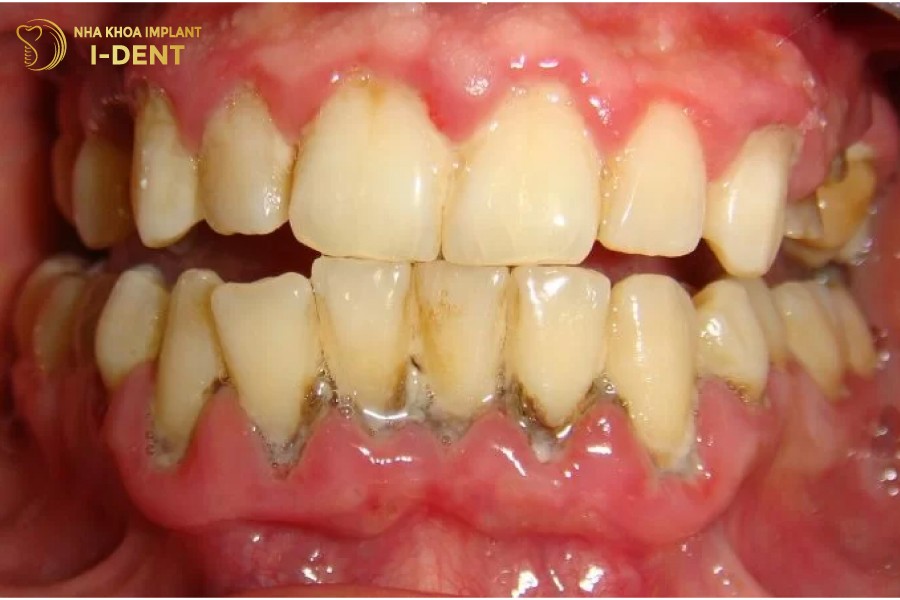 Tut-loi-gay-anh-huong-lon-den-suc-khoe-rang-mieng