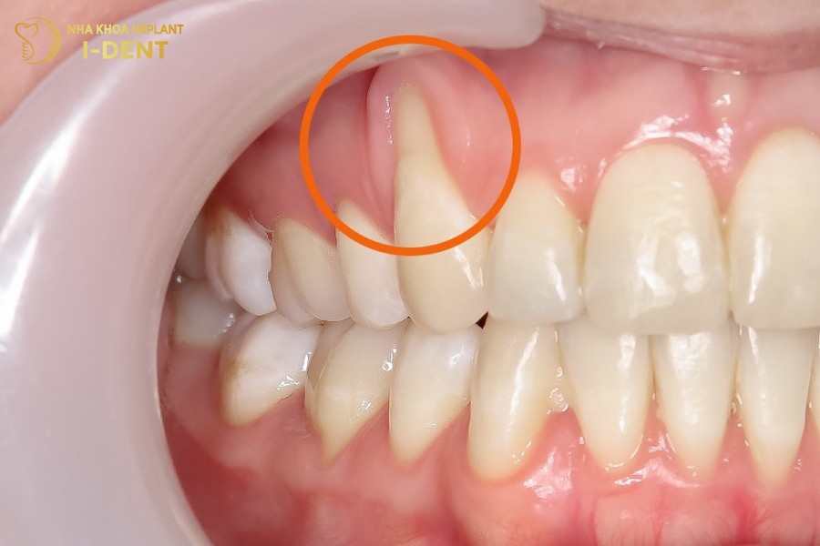 Tut-loi-gay-ho-chan-rang