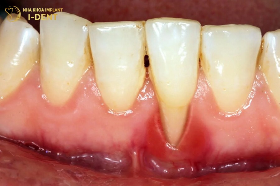 Tut-loi-vua-gay-mat-tham-my-vua-anh-huong-suc-khoe-rang-mieng