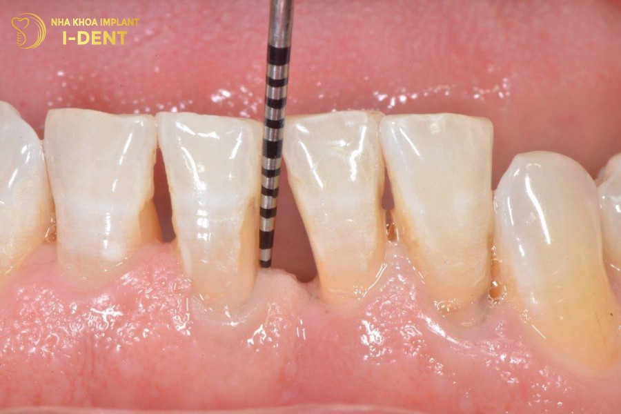 Tut-nuou-lam-lo-ca-chan-rang-ra-ben-ngoai