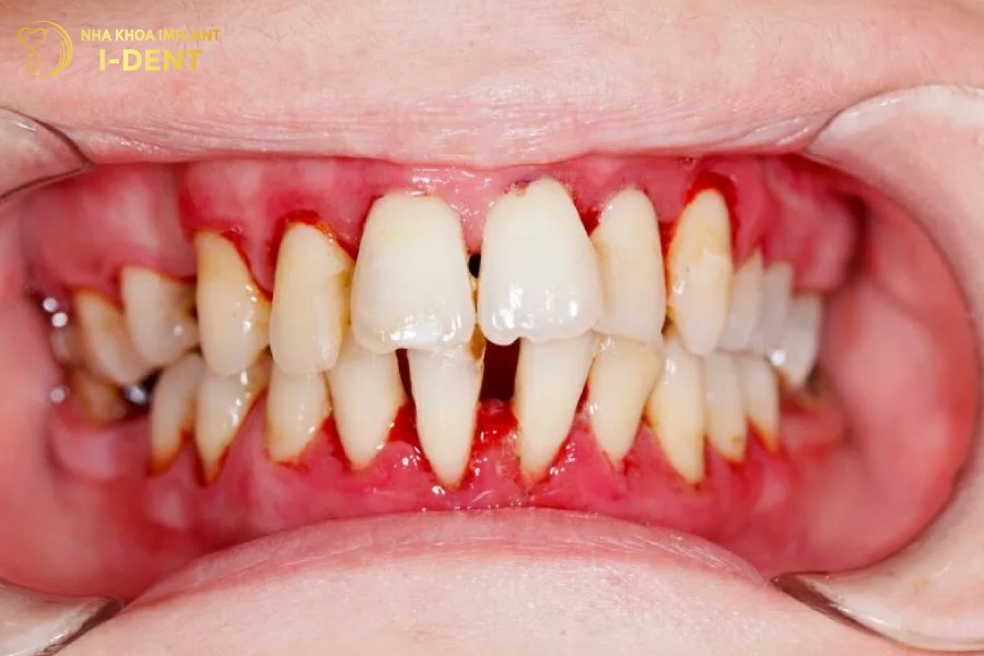 Viem-loi-la-nguyen-nhan-hang-dau-gay-tut-nuou