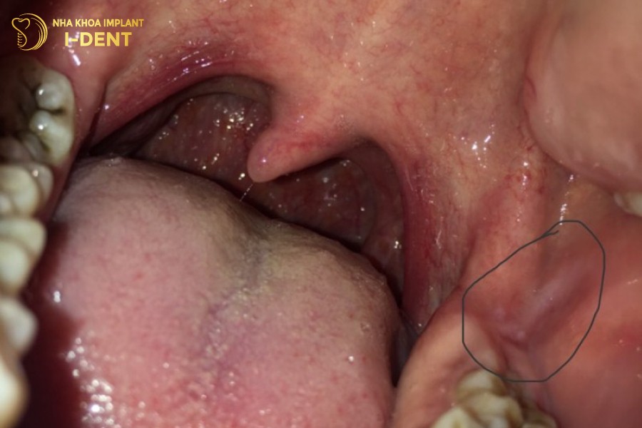 Xuat-hien-dom-trang-khi-moc-rang-khon