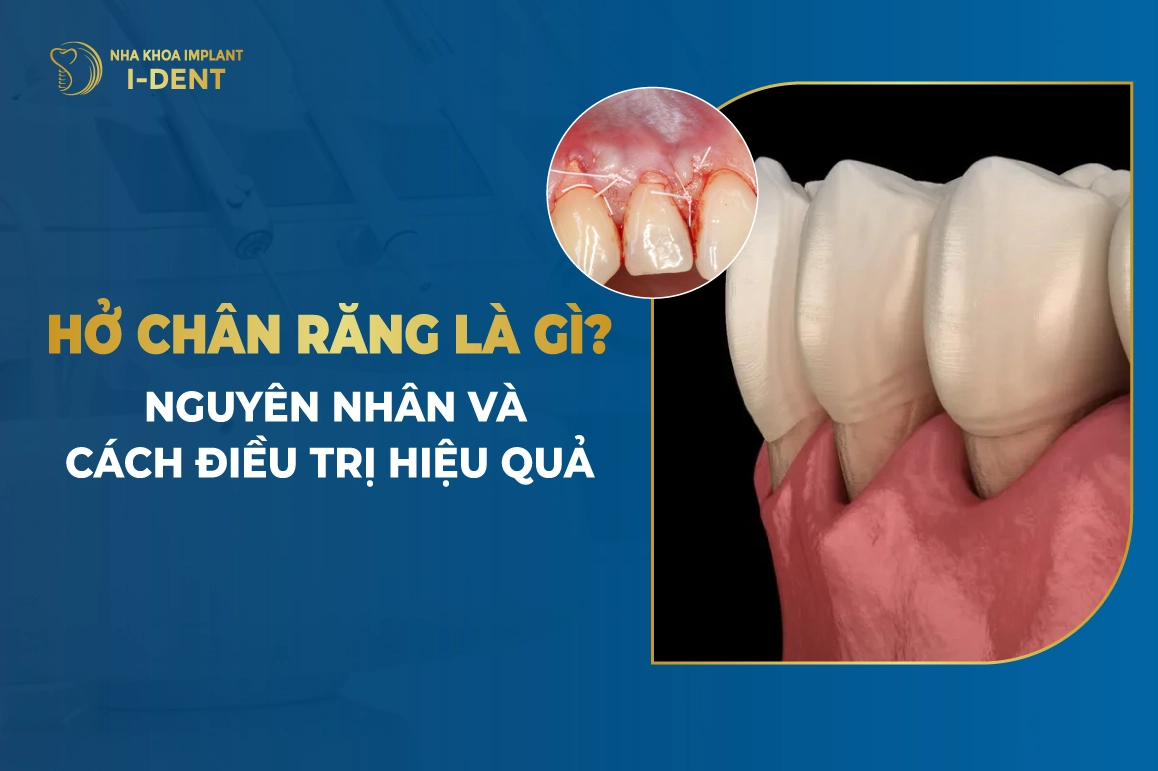 Hở Chân Răng Là Gì? Nguyên Nhân Và Cách Điều Trị Hiệu Quả