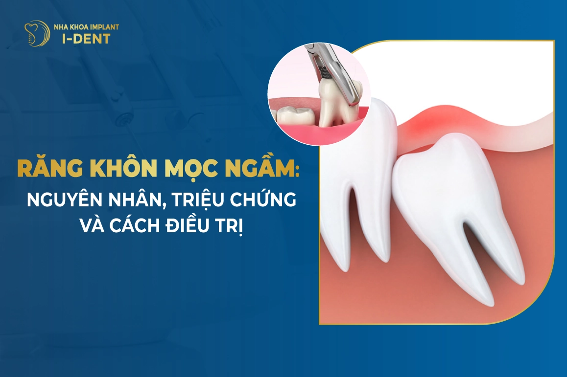 Răng Khôn Mọc Ngầm: Nguyên Nhân, Triệu Chứng Và Cách Điều Trị