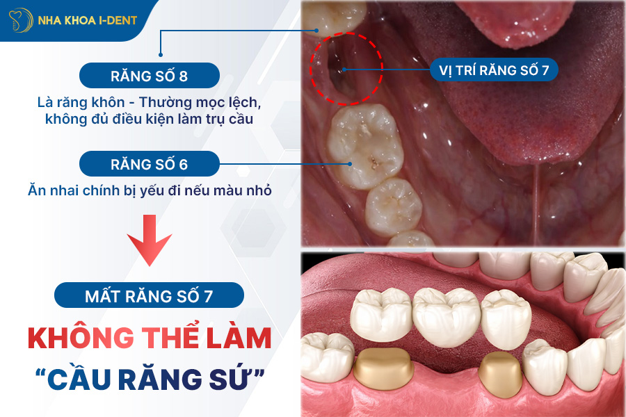 trồng răng số 7 giá bao nhiêu