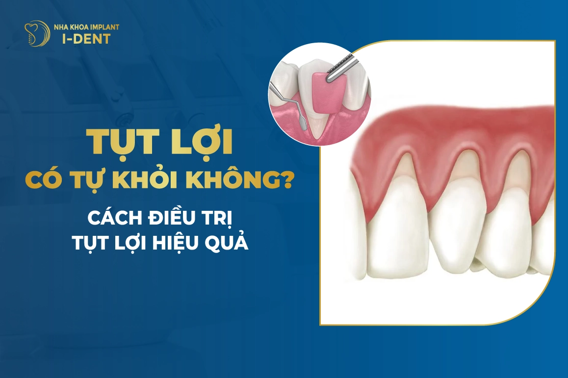 Tụt Lợi Có Tự Khỏi Không? Cách Điều Trị Tụt Lợi Hiệu Quả
