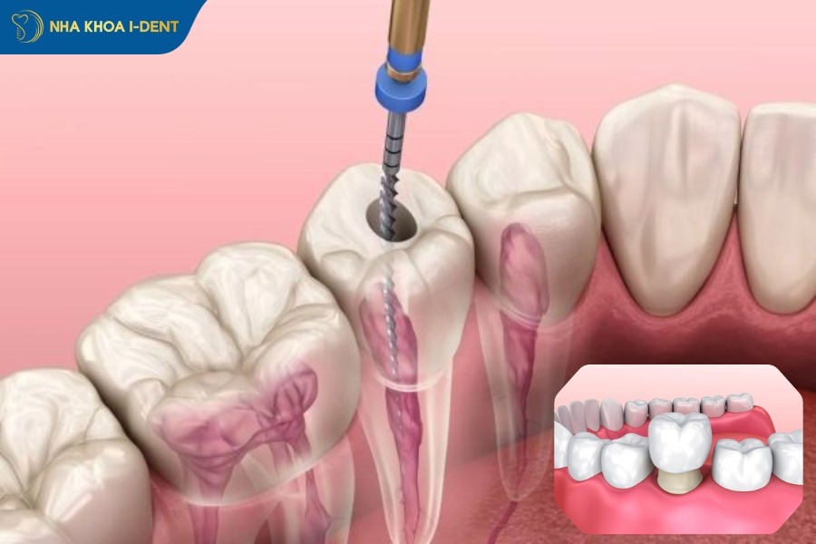 răng bị sâu làm sao hết