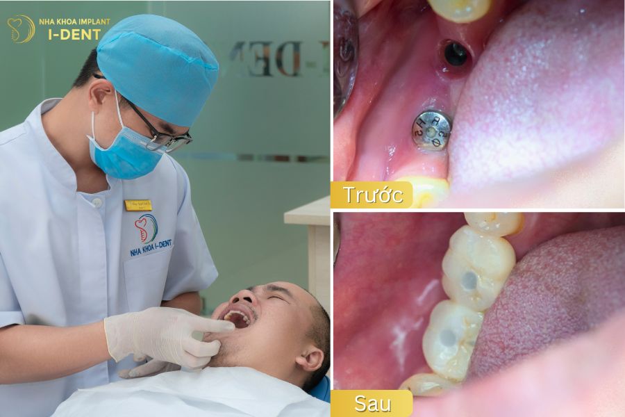 Bác sĩ Tín Cấy ghép Implant cho bệnh nhân có tiền sử bệnh tiểu đường và huyết áp