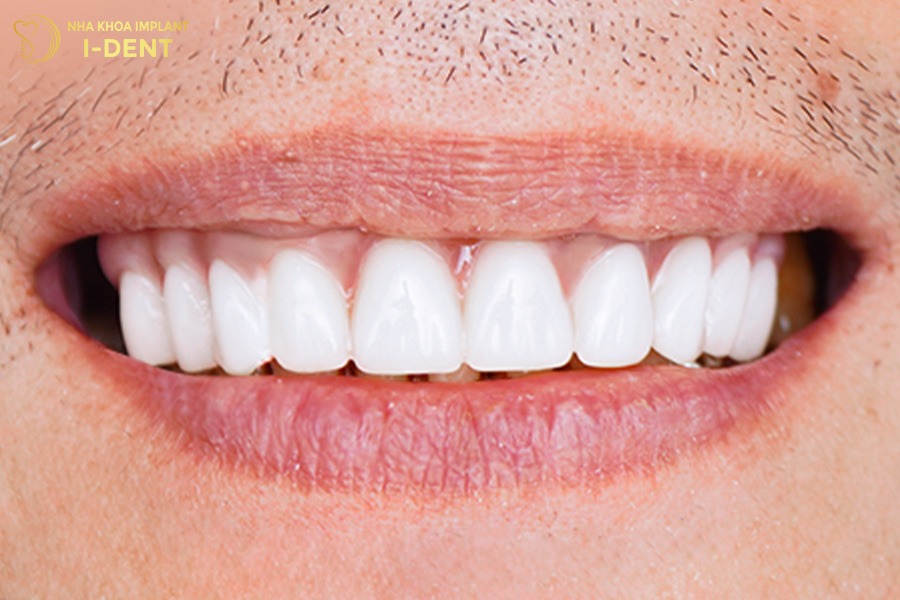 Tình trạng răng sau khi Cấy ghép Implant của chú Văn Sự