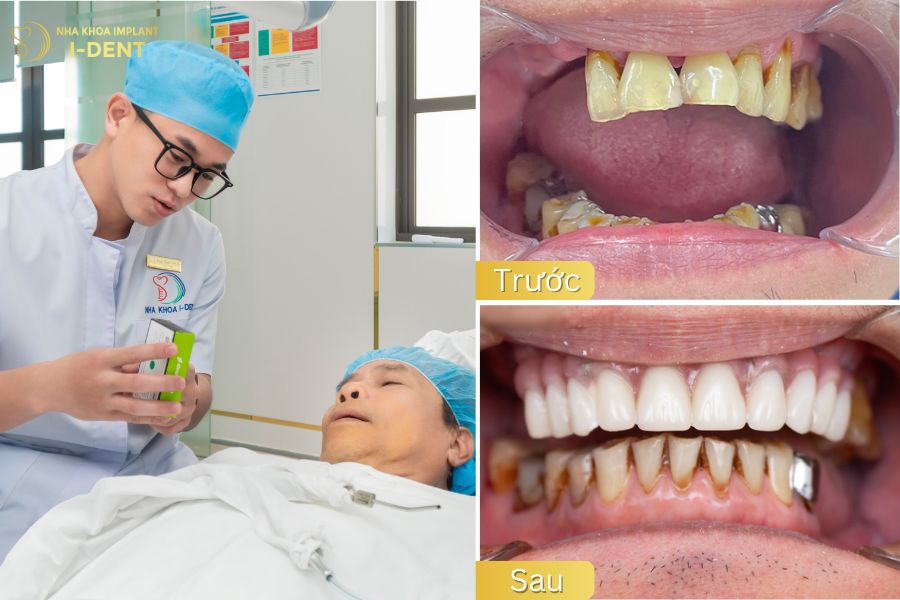 Bác sĩ Tín Cấy ghép Implant toàn hàm All-on-4