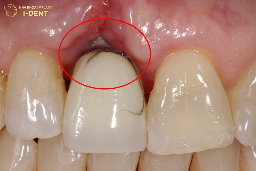 trồng implant có bị hôi miệng không