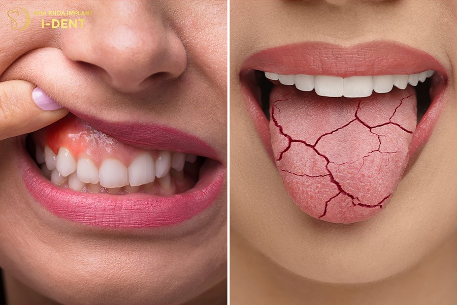 trồng răng implant có hút thuốc được không