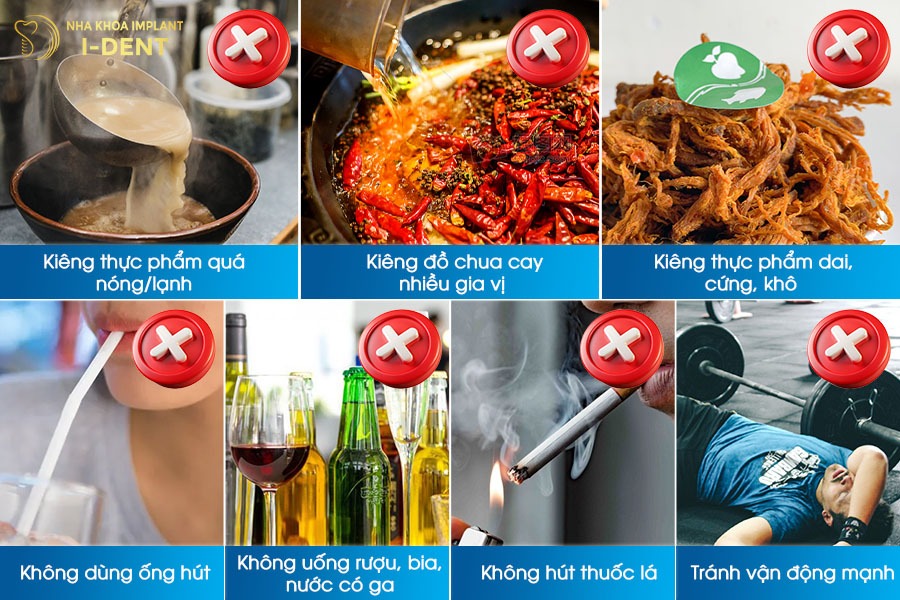 trồng răng implant kiêng ăn gì