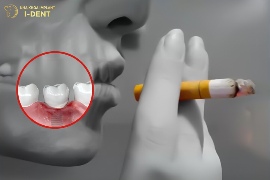 trồng răng implant hút thuốc được không