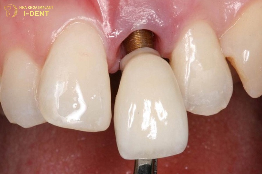 trồng răng implant thì có hút thuốc được không