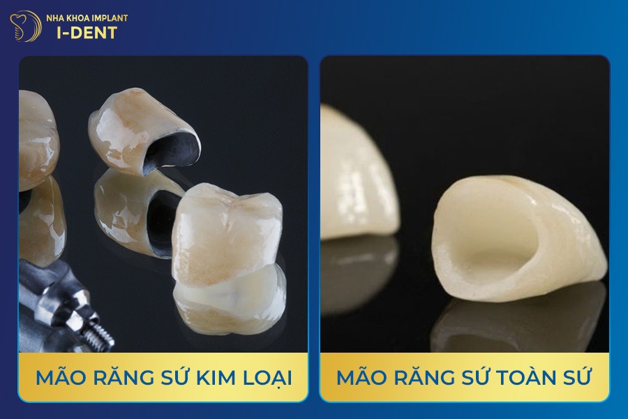 cấu tạo răng implant