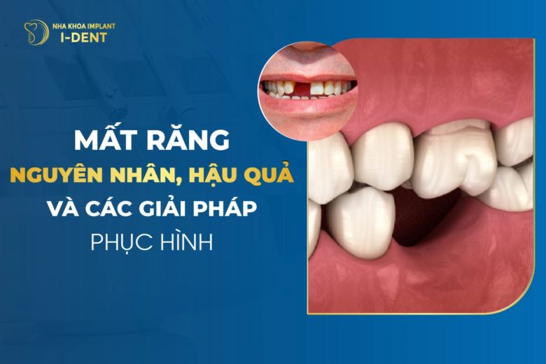 Mất răng có sao không? Nguyên nhân, hậu quả và cách khắc phục