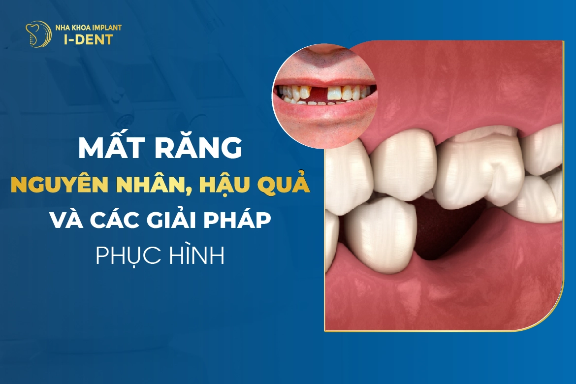 Mất răng có sao không? Nguyên nhân, hậu quả và cách khắc phục