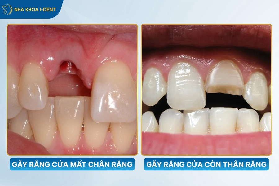 bị gãy răng cửa phải làm sao