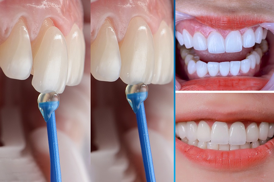 bọc sứ không mài răng