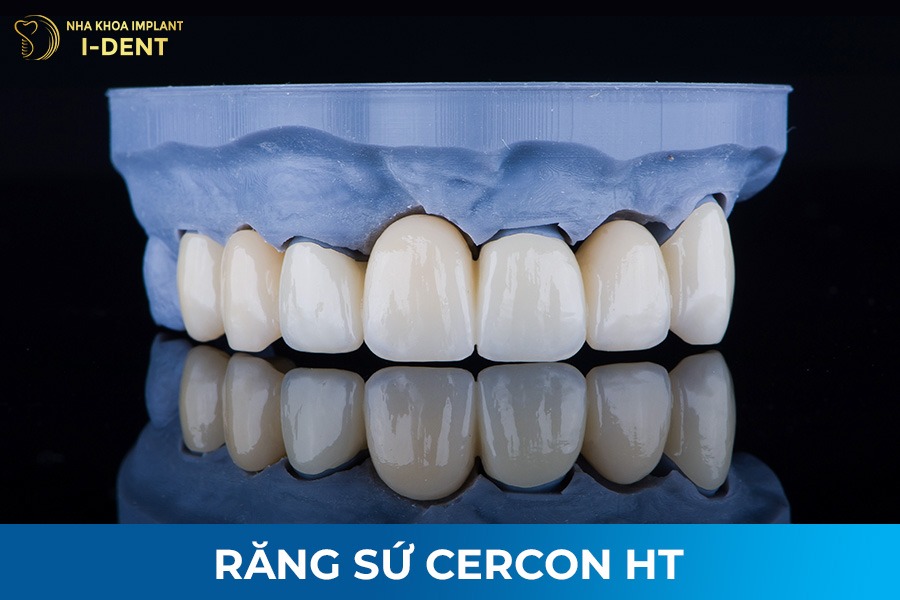 các loại răng toàn sứ