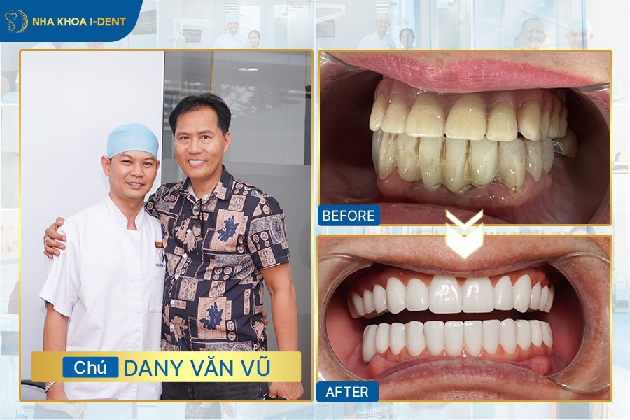 implant biotem hàn quốc