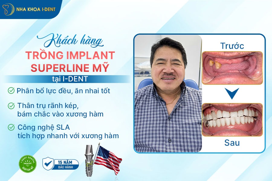 implant hiossen của mỹ;