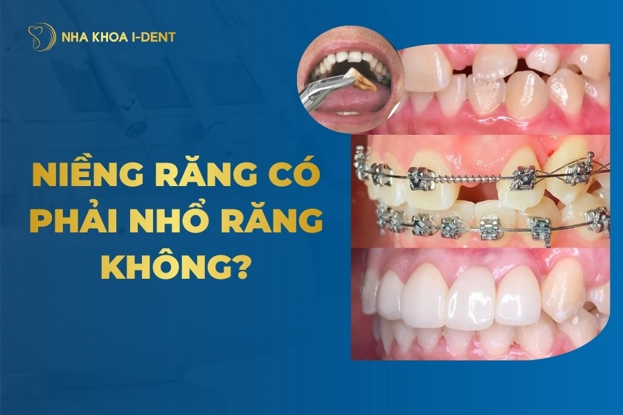 Niềng răng có phải nhổ răng không? Ai không cần nhổ?