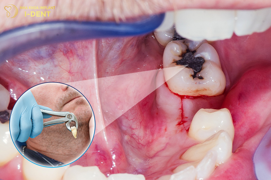 nhổ răng vĩnh viễn