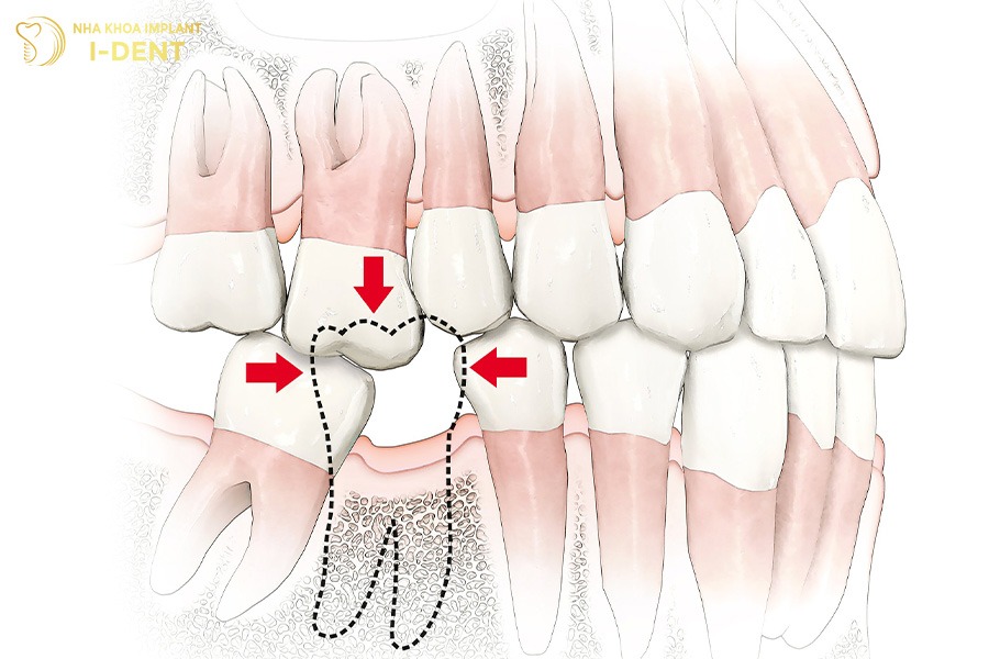 nhổ răng vĩnh viễn có ảnh hưởng gì không