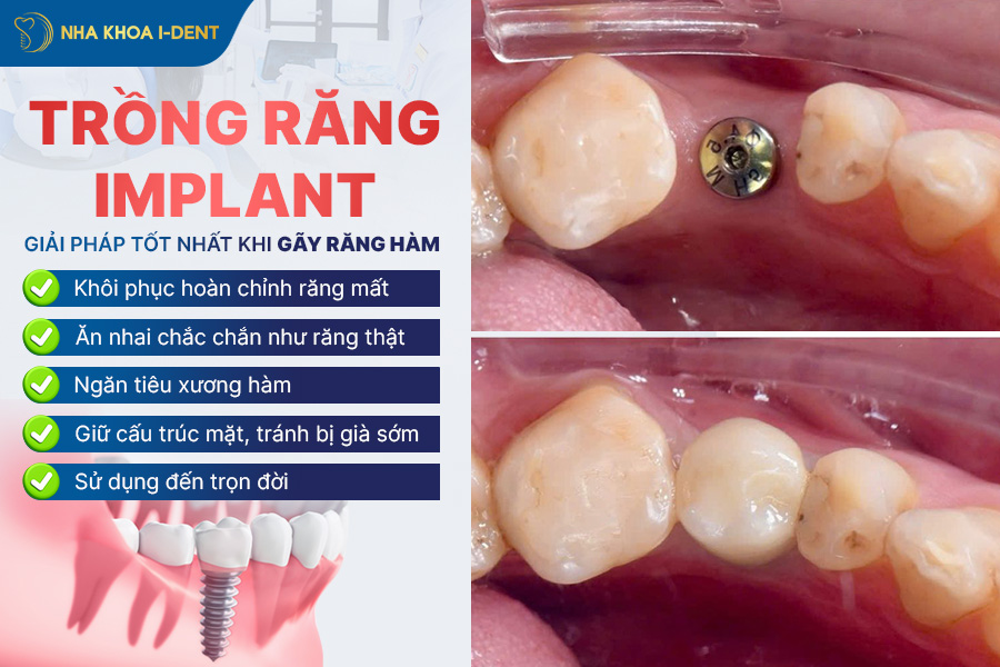 gãy chân răng có mọc lại không