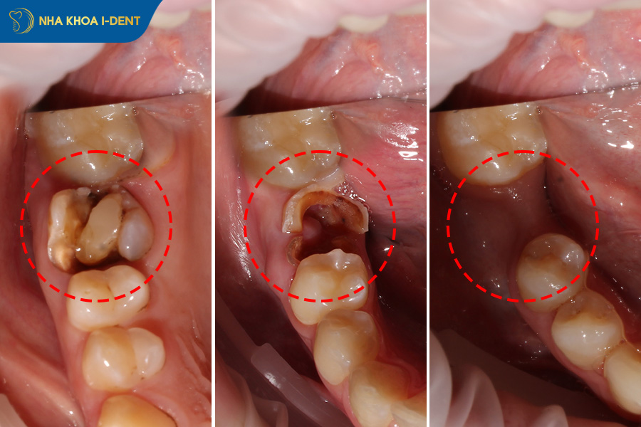 Gãy răng hàm có mọc lại không
