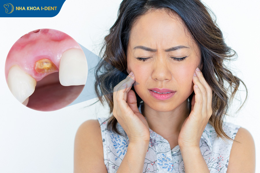 gãy răng hàm dưới có mọc lại không