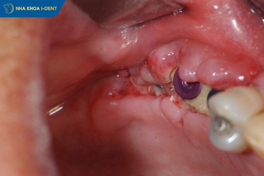 hối hận khi cấy implant