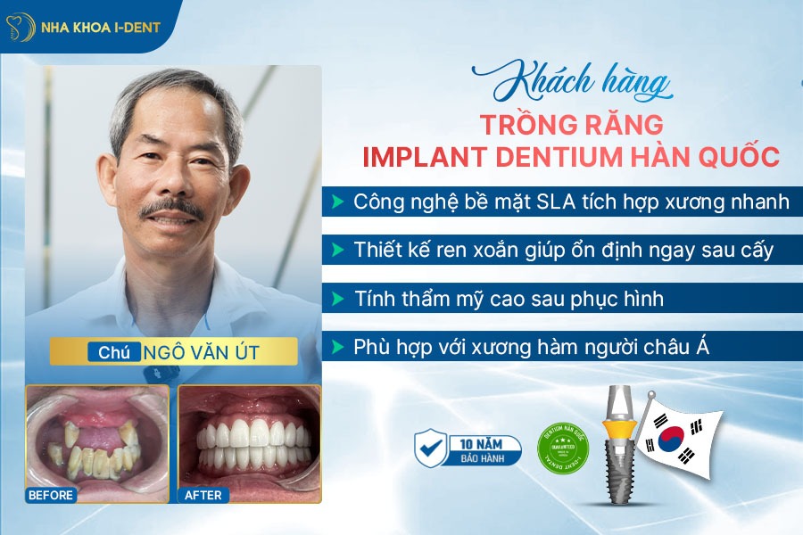 implant hàn quốc