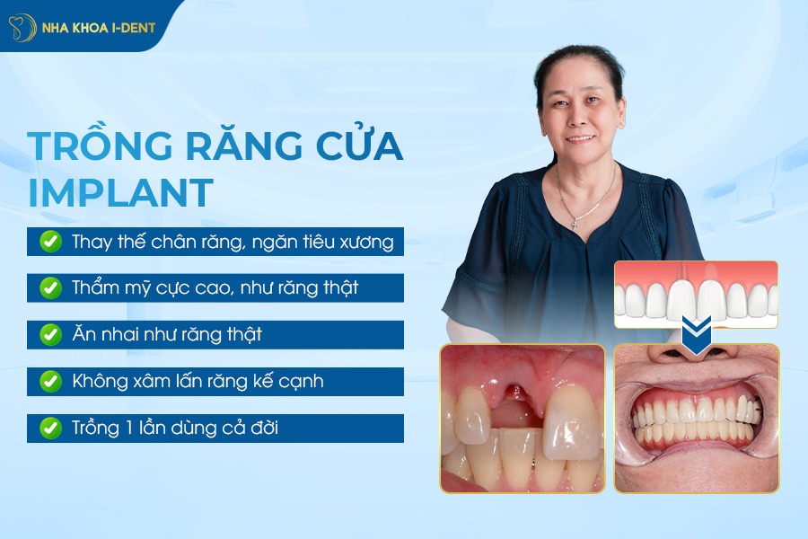 implant răng cửa