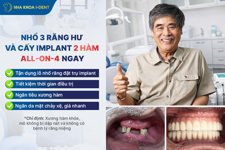 nhổ răng bao lâu thì cấy implant
