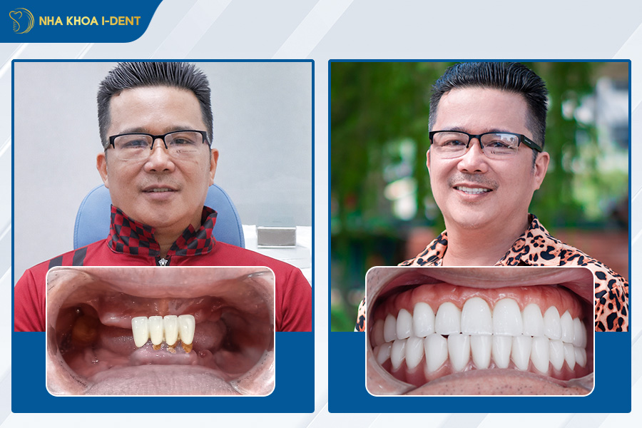 nhổ răng xong bao lâu cấy implant