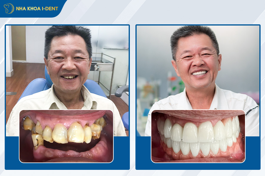 nhổ răng bao lâu trồng implant