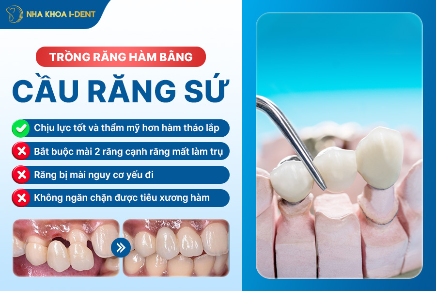 răng hàm có trồng được không