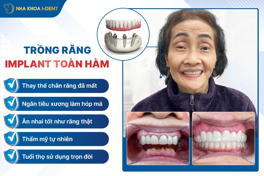 trồng răng implant nguyên hàm