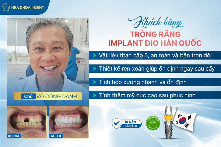 trụ răng implant Hàn Quốc