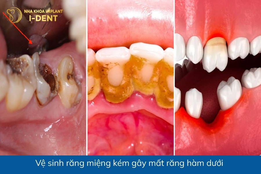 mất răng hàm dưới có nguy hiểm không