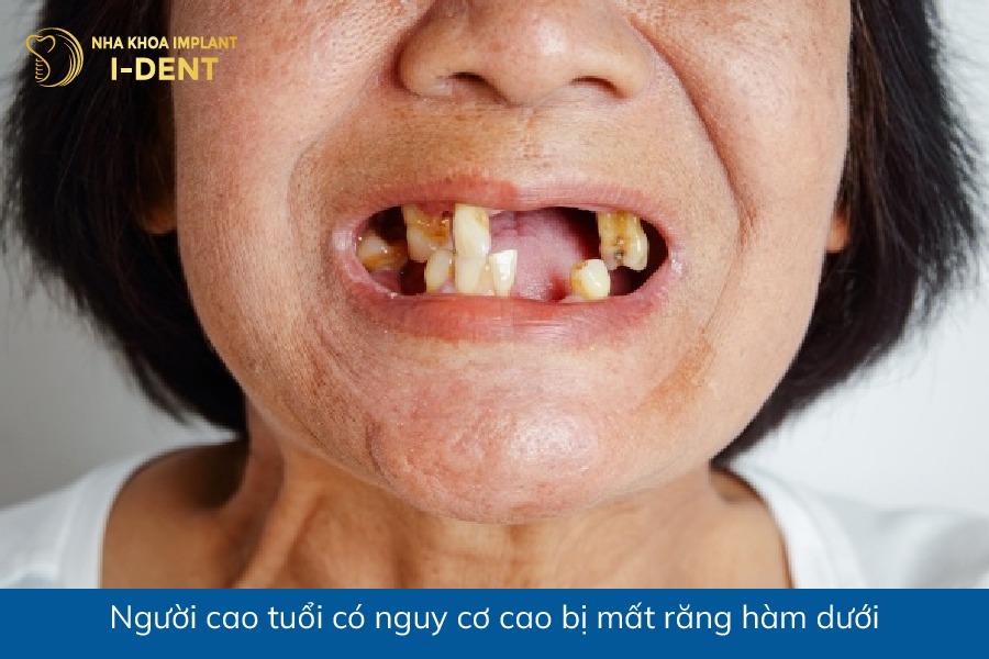 Người cao tuổi có nguy cơ cao bị mất răng hàm dưới