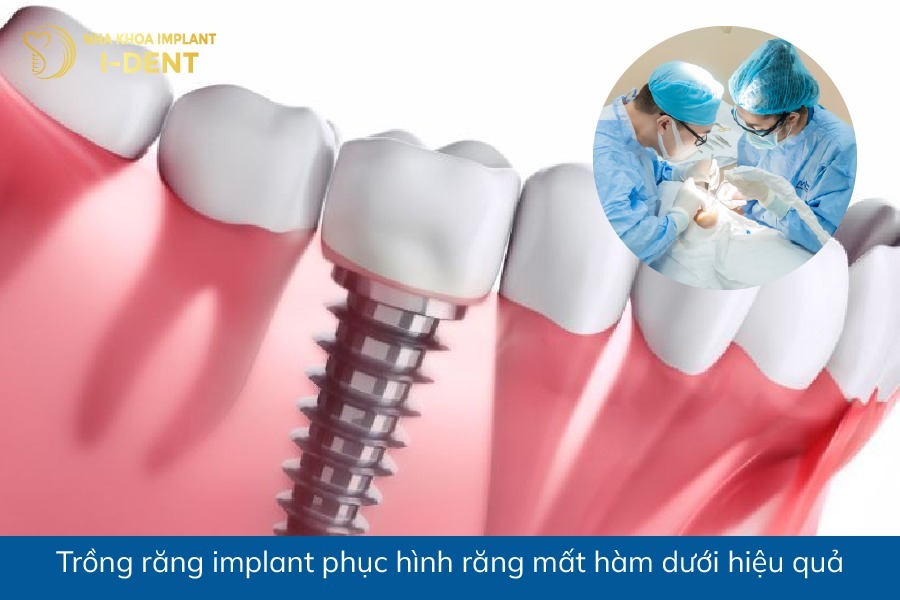 mất răng hàm ở dưới