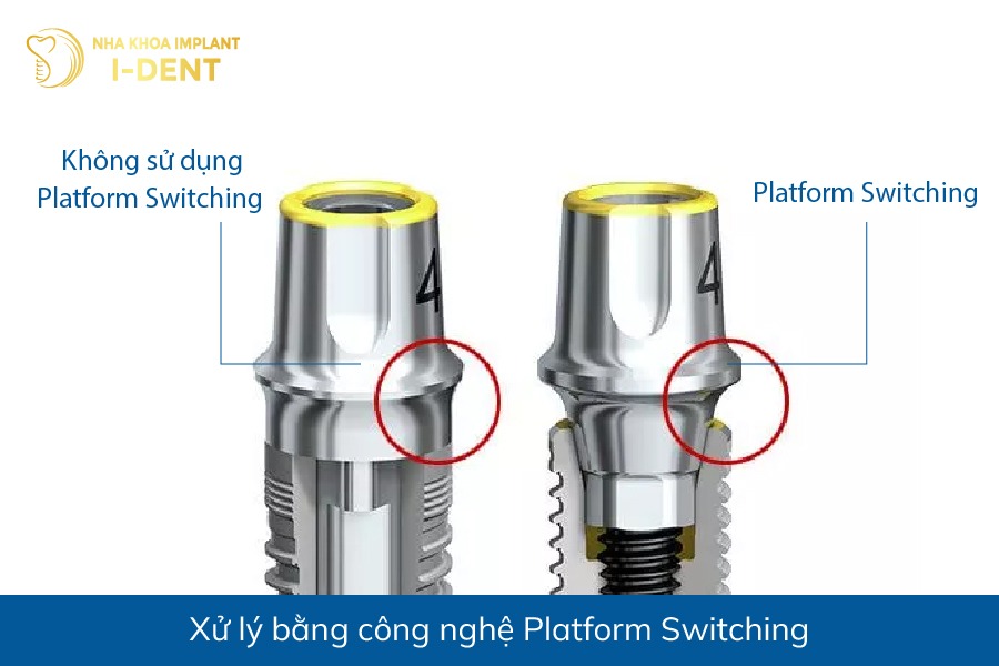 sự khác nhau giữa các loại implant