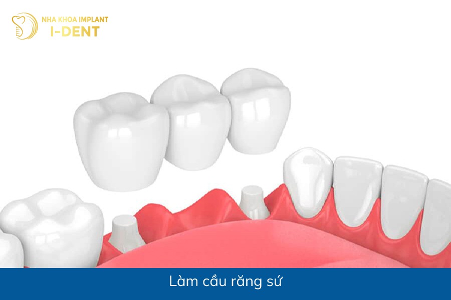 mất các răng hàm dưới