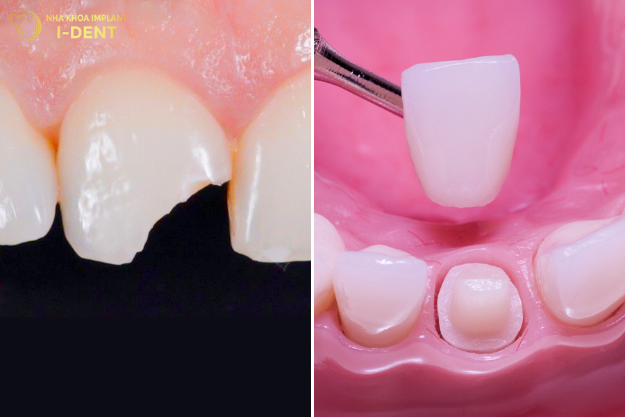 răng bị gãy chân